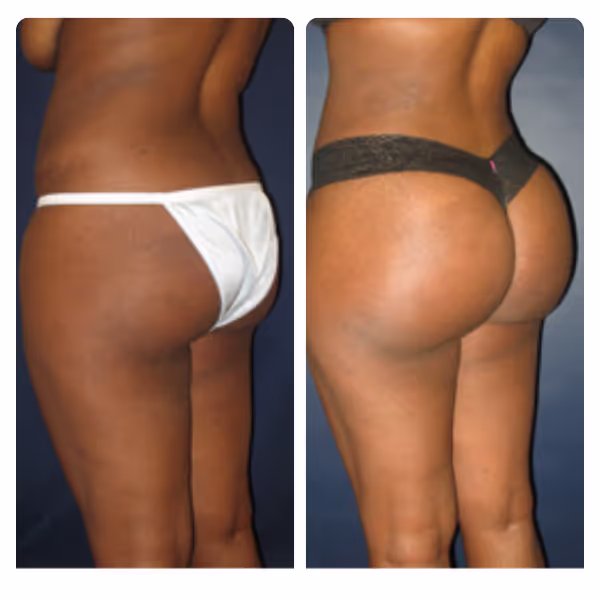 Brazilian Butt Lift (BBL) in Turkey